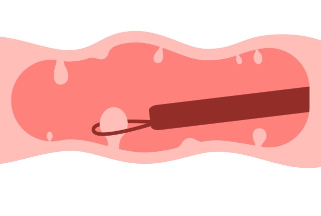 大腸ポリープ切除のイラスト