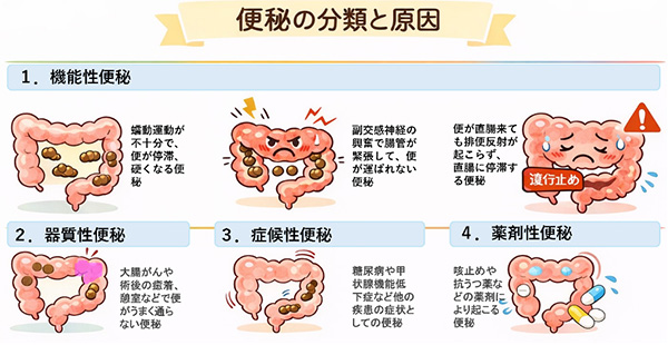 便秘の分類と原因