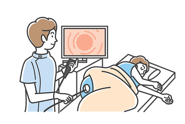 大腸カメラ検査イラスト