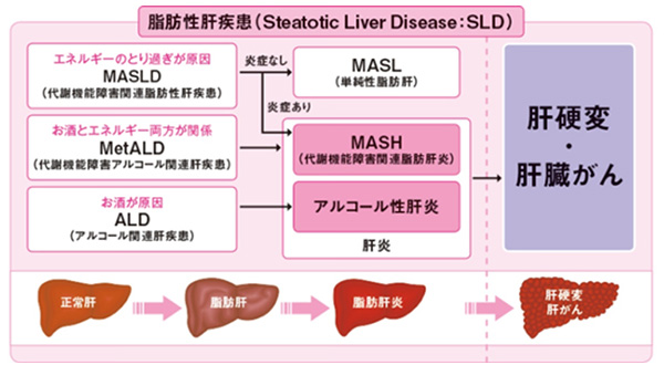 脂肪性肝疾患(Steatotic Liver Disease:SLD)